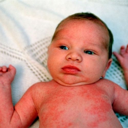 Появление красных пятен на коже ребёнка – симптомы потницы (фото: otpotlivosti.ru.)
