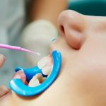 Белые пятна на молочных зубах: профилактика, лечение и причины возникновения