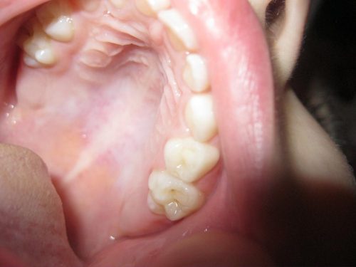 Последними выпадают вторые коренные зубы – моляры (Ева.Ру)