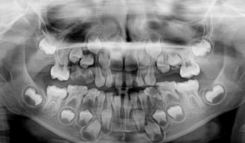 Если молочные зубы долго не выпадают, постоянные могут начать расти еще одним рядом (фото: Клиника доктора Машукова)