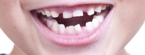 Прорехи от выпавших зубов (фото: www.sandora.in.ua)