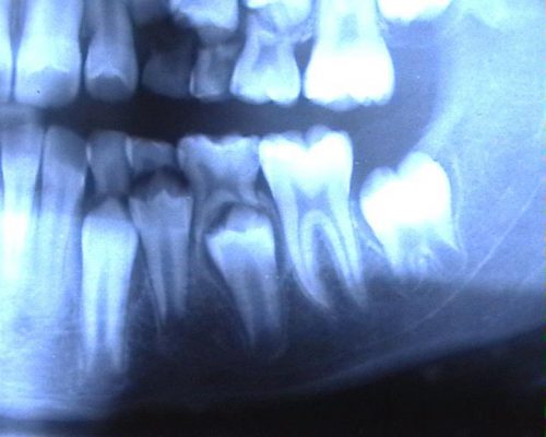Так выглядит челюсть ребенка на рентгеновском снимке (фото: www.klubkom.net)