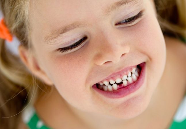 Молочные зубы обычно сами выравниваются по мере роста ребенка (фото: стоматологический портал для пациентов Startsmile)