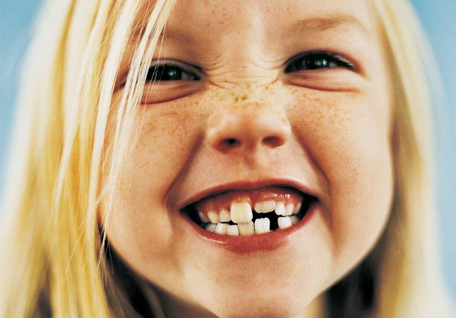 Если у ребенка сломался или откололся молочный зуб — его можно восстановить (фото: hospitaldenens.com)