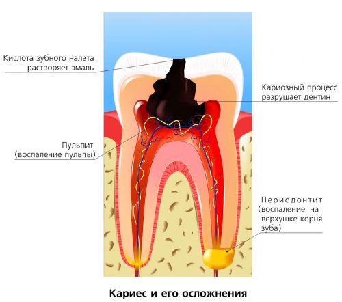 Пульпит молочного зуба – это одно из осложнений кариеса (фото: blogspot.com)