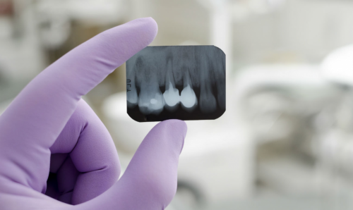 Длительность лечения и методика, зависят от степени поражения зуба (фото: dentalix.ru)