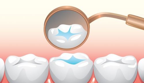 Пломба поможет продлить срок службы молочного зуба и сохранить его форму (фото: linkedin.com)
