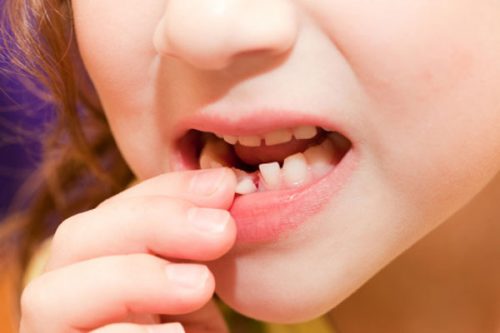Вырвать в домашних условиях можно только молочный зуб, но не коренной (фото: www.medicine.net)