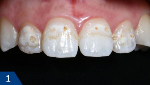 Кариес молочного зуба может проходить без болевых ощущений и дискомфорта (фото: www.zdoroviezubi.com)