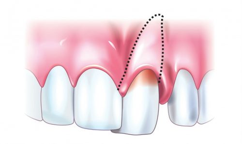 Воспаление десны из-за травмы зуба может стать причиной задержки роста нового (фото: Doctoroff.ru)