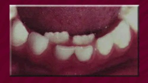 Не исключается и тот факт, что постоянные зубы могут прорезаться еще при временных (фото: cyberspaceandtime.com)