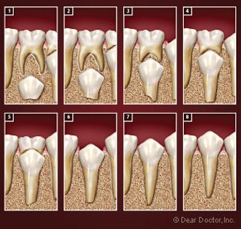 Посмотрите, как корень молочного зуба выполняет свою защитную функцию (фото: deardoctor.com)