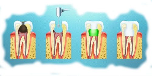 Процесс лечения зуба консервативным методом (фото: myimplant.ru)