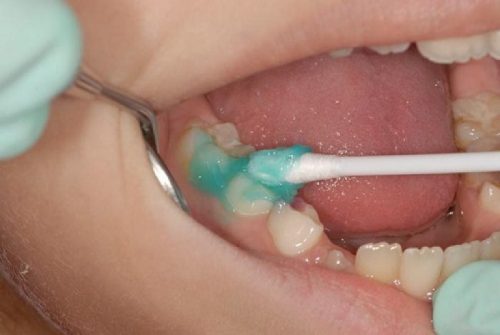Для проблемных молочных зубов лечение – единственная возможность сохранения (фото: www.detki-zdorovy.ru)