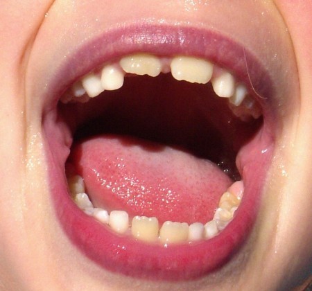 Разница между двумя типами зубов (фото: oralanswers.com)