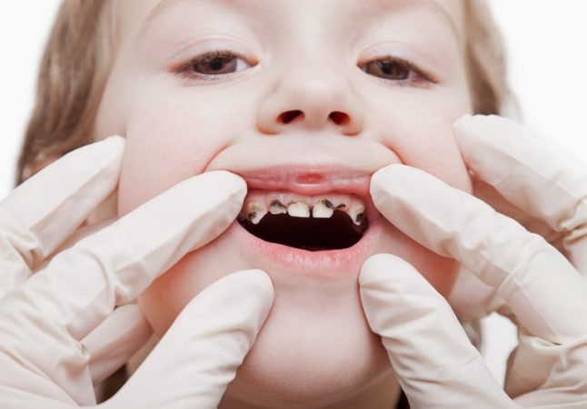 У ребенка диагностировали обширное поражение микробами тканей зуба (фото: www.4allwomen.ru)