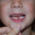 Что делать, если ребенок проглотил молочных зуб
