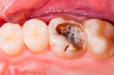 Так выглядит зуб при острой форме болезни (фото: www.anle-dent.ru)