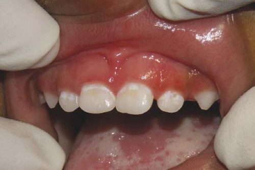 Белые пятна на временных зубах являются первыми предвестниками кариеса (фото: www.recept.znate.ru)