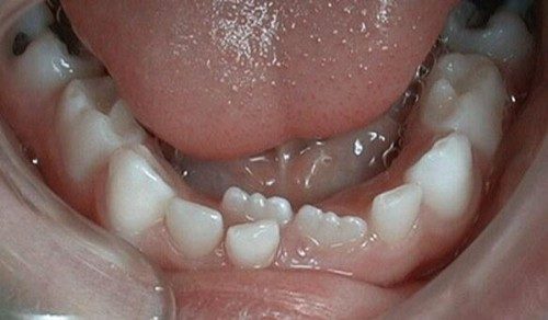 Осложнение из-за преждевременного выпадения кариозного зуба (фото: www.lecheniedetok.ru)