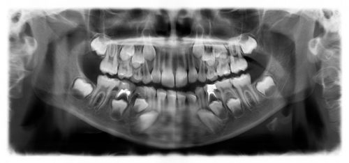 Рентген-снимок челюстей 7-летнего ребенка: молочные и прорезывающиеся зубы (фото: 32dent.ru)