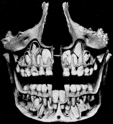 Рентген молочных зубов на этапе смены коренными зубами (фото: forbes.com)
