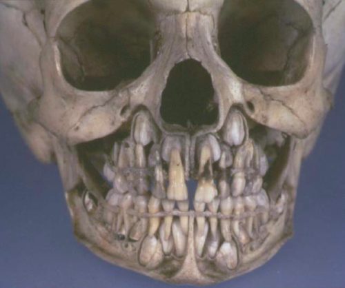 Снимок молочных зубов, на смену которым вскоре придут коренные (фото: viralnova.com)
