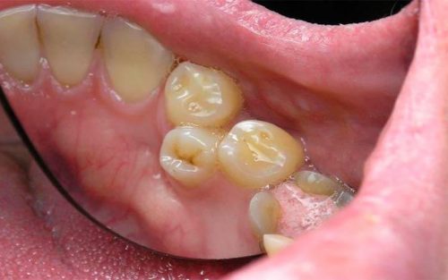 Аномалия прикуса из-за преждевременного выпадения зуба (фото: gm-stoma.ru)