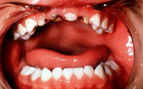 Фторирование не проводится, если зуб невозможно спасти (фото: stomgid.ru)