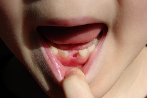 Лунка от молочного зуба (фото: topdent.ru)