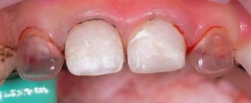 Вид зубов, восстановленных с помощью strip-коронок (фото: www.vash-dentist.ru)