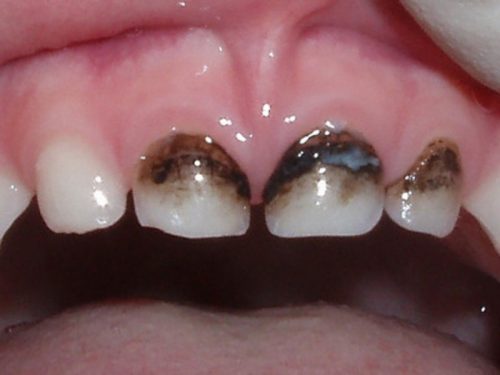 На фото молочные зубы после использования методики (фото: www.stoma.guru)