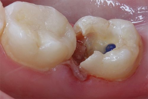 Вид зуба с отколотым куском пломбы (фото: www.plomba911.ru)